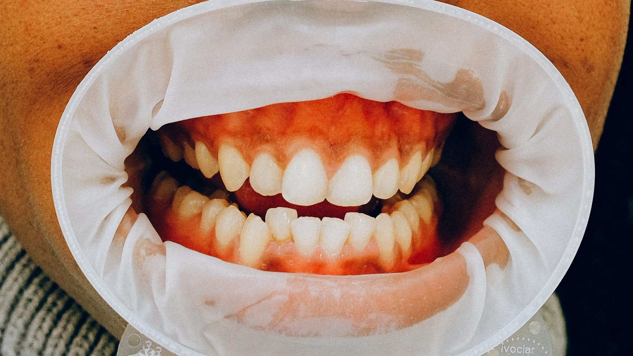 chica-preparendose-para-limpieza-dental