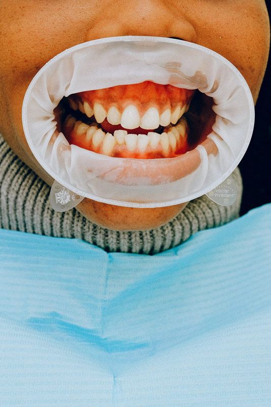 limpieza dental biozero